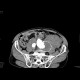 Aneurysm of abdominal aorta, AAA, ruptured, retroperitoneal bleeding: CT - Computed tomography